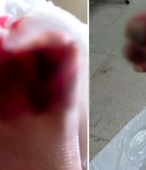 Idoso tetraplégico tem dedos esmagados por elevador de ônibus em Santos, SP