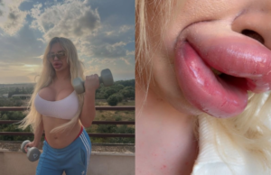 Influenciadora trans gasta R$ 1 milhão em procedimentos estéticos e enfrenta complicações