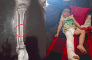 Criança de 2 anos fratura a perna após brigar com colega na creche.